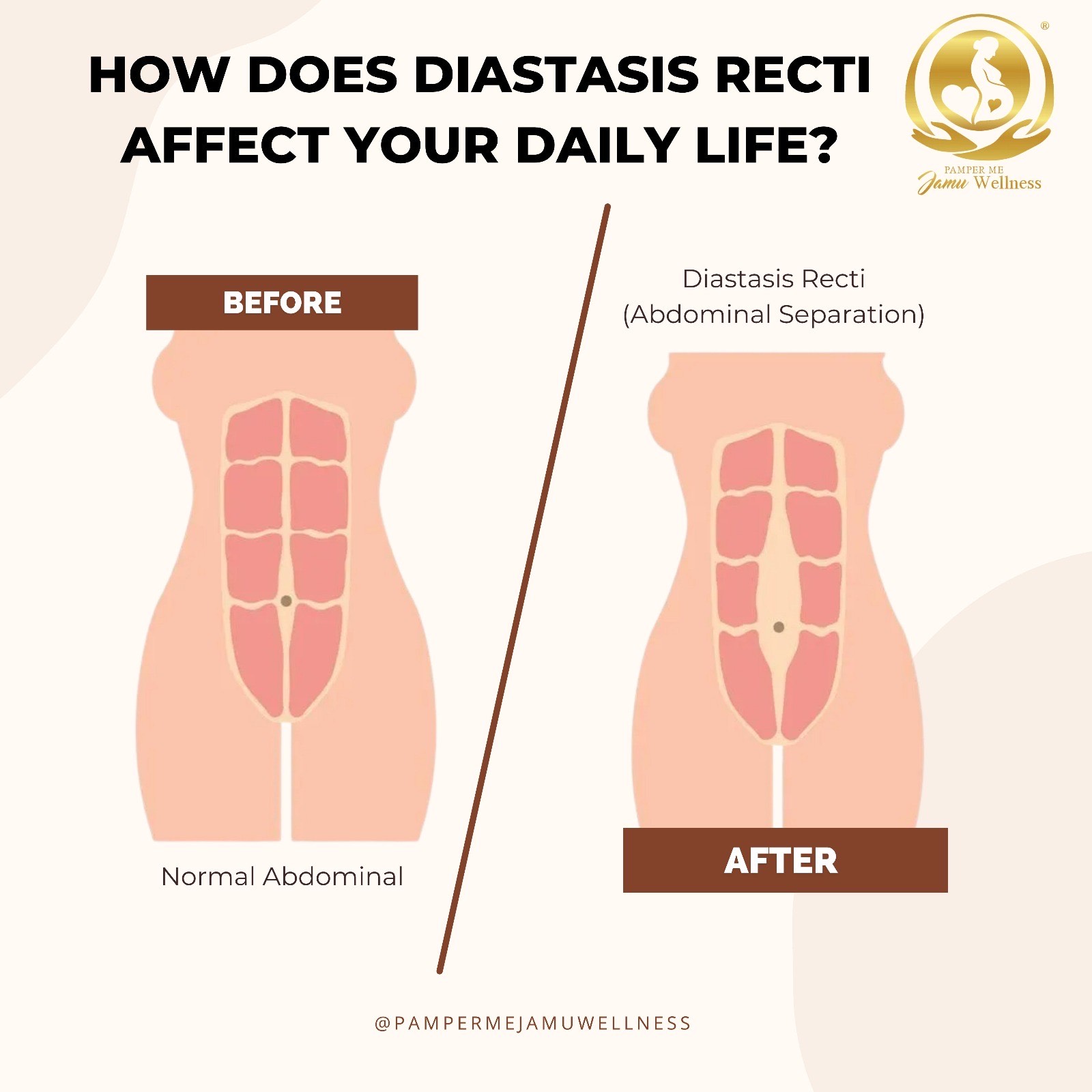 *Deposit First* Pamper Me Jamu Wellness 5 X 90mins Post Natal With Hot Stone Therapy + 5 X 90mins Diastasis Recti Treatment With Hot Stone Therapy + FREE GIFT